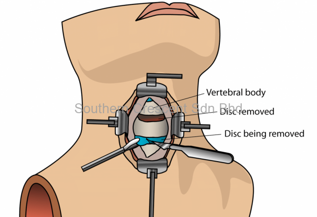 Neck Surgery