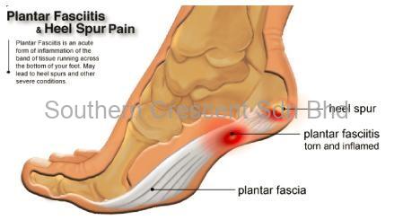 Heel Spur Pain