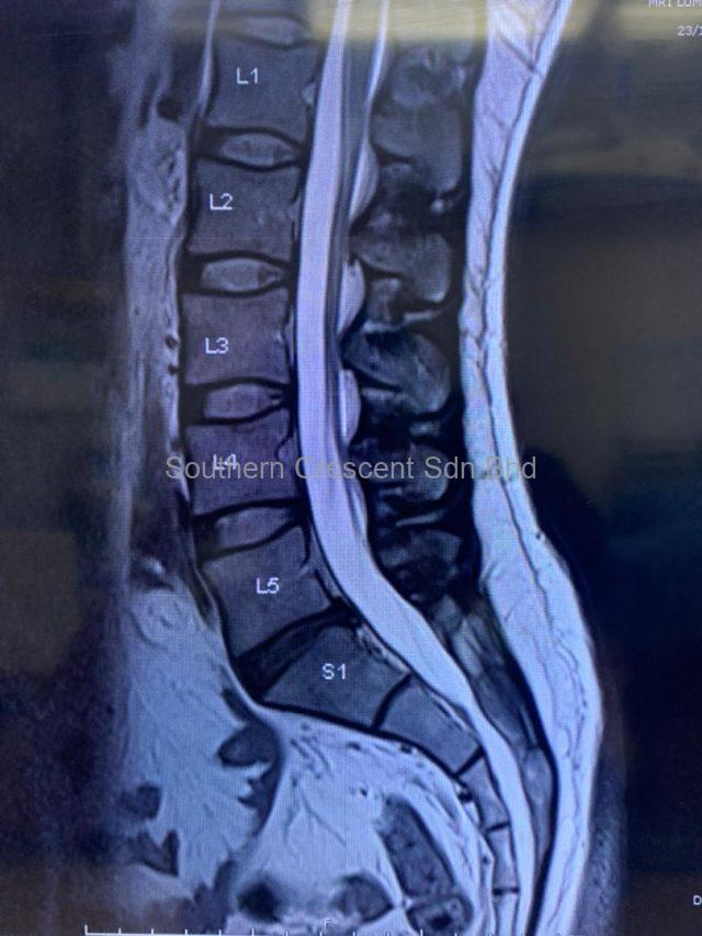 Figure 1 shows the disc in the L5S1 level is blackish on MRI