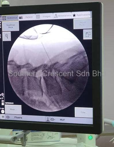 Figure 3 shows a needle inserted into L5S1 disc