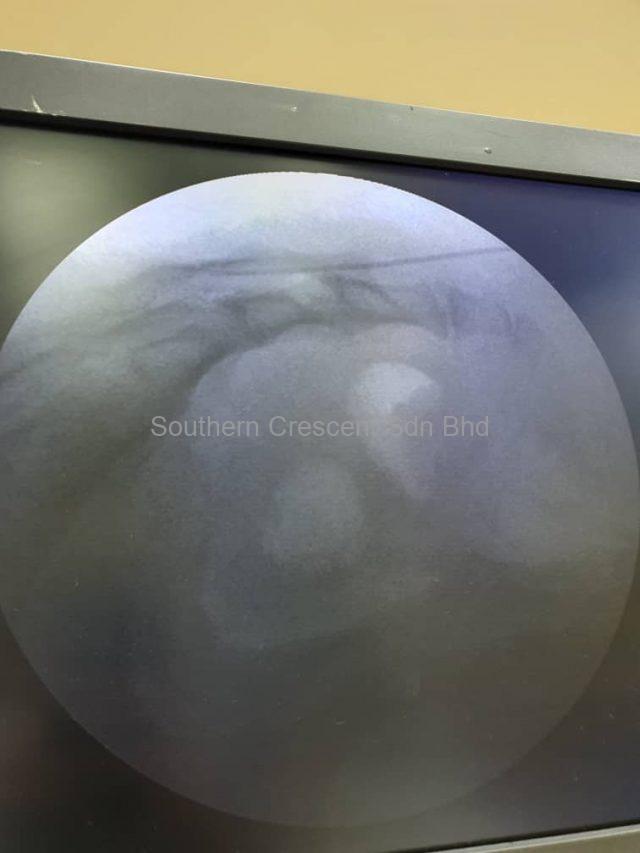Figure 2 shows a needle inserted into the sacral epidural space via the sacral hiatus